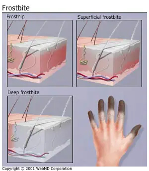 3 stages of frostbite