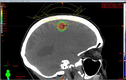 Brain CT