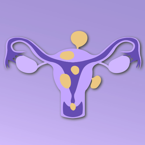 Fibroid Fundamentals