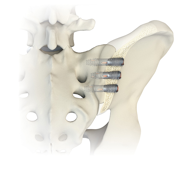 The system employs titanium alloy implant screws that secure the SI joint. A bone graft encourages fusion across the joint. Illustration: Genesys Spine