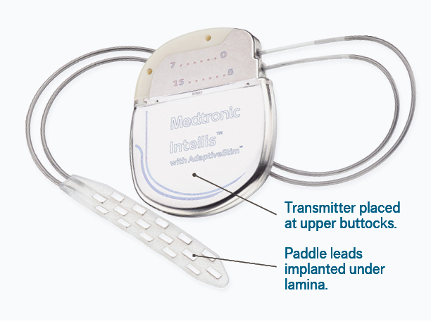 Spinal Cord Stimulator