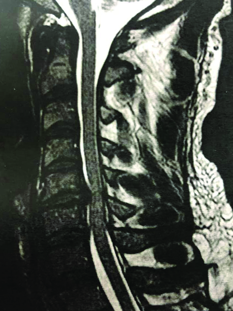 An MRI shows Brent’s injury.  