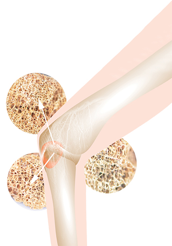 Osteoporosis knee illustration