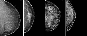 Breast Density