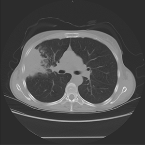 low-dose chest CT