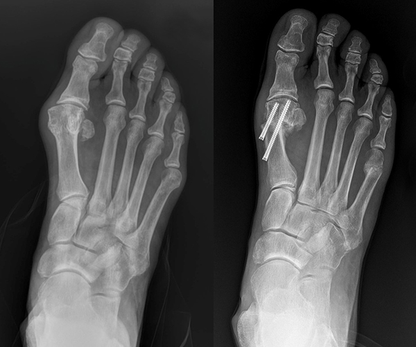 Before (left) and after X-rays show how minimally invasive bunion surgery realigns bones to their natural position.