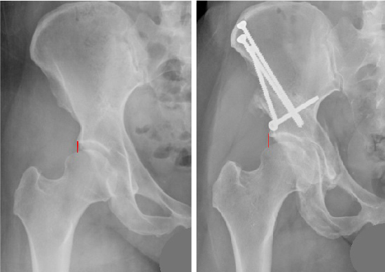 Images show native hip joint with subtle dysplasia before (left) and after PAO (right). The red lines indicate the acetabulum's edge and femoral head coverage (left), and how the latter increased after surgery (right).