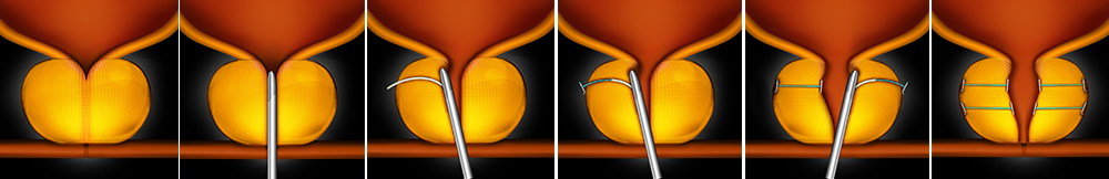 UroLift procedure