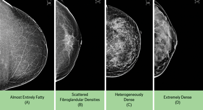 Breast Density