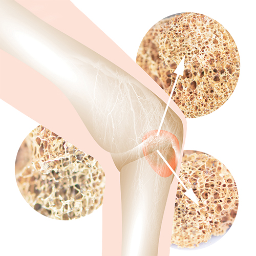 Inf&oacute;rmese Sobre la Osteoporosis