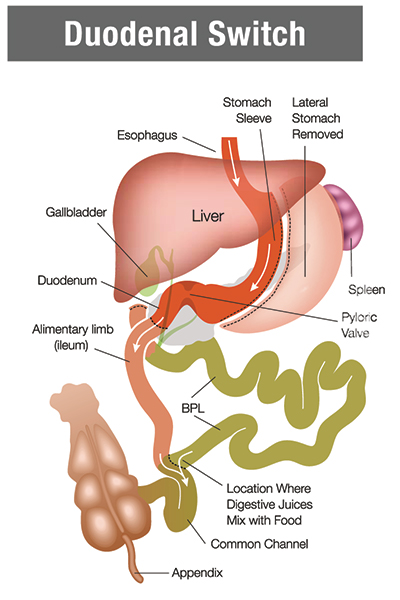 Duodenal switch