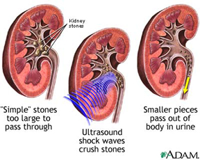 kidney stones